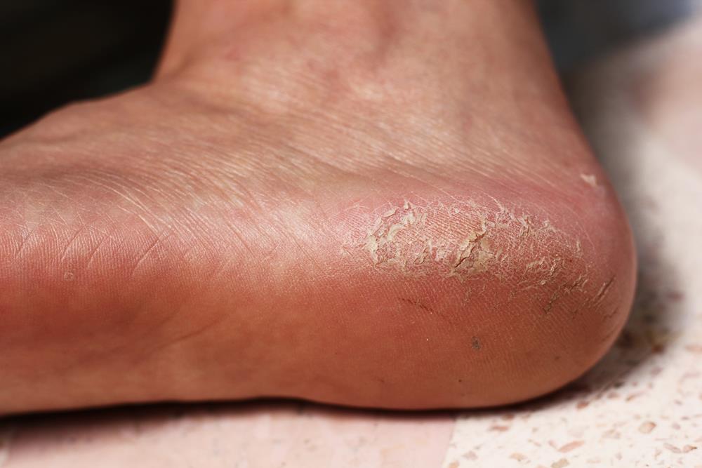 Calluses Serving San Francisco, CA